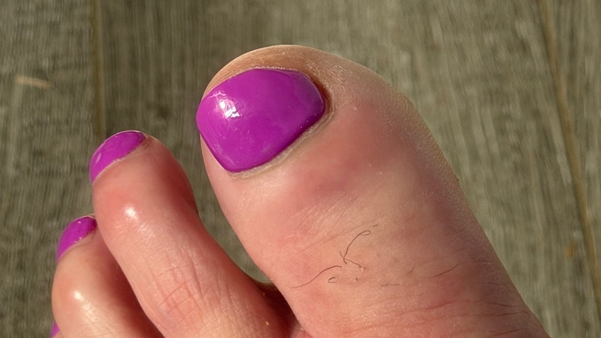 More women come forward after sepsis case linked to pedicure