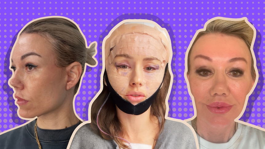 Plastic surgeons warn of complications as Australians seek face lifts overseas
